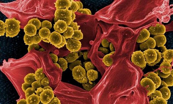 Bakteriyel prostatitin bir nedeni olarak Staphylococcus aureus