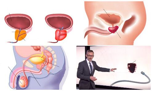 sağlıklı ve hastalıklı prostat